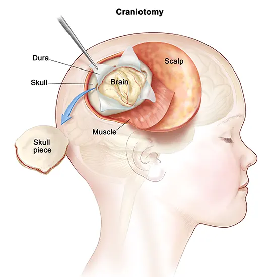 brainstem glioma